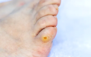 A podiatrist can safely and effectively remove corns on feet.