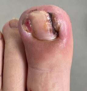 A skilled podiatrist can perform a painless and permanent removal of ingrown toenails using specialized techniques.