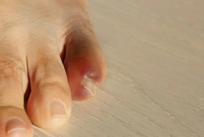 A twisted toe, often the result of sudden trauma or repetitive stress, can cause pain and discomfort.