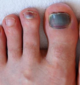 Running can lead to a bruised toenail due to the repetitive impact of the foot hitting the ground.
