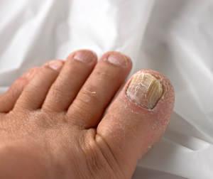 Toenail fungus, if left untreated, can lead to the development of dry, brittle toenails.