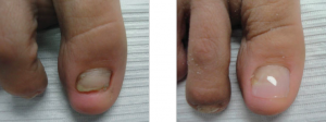 KeryFlex is a innovative cosmetic solution that transforms and restores the appearance of damaged or unsightly toenails.
