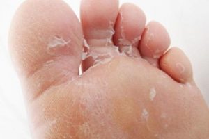 Chronic athlete's foot presents persistent challenges due to recurring fungal infections on the feet.