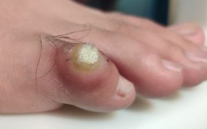Visit a Houston podiatrist for efficient and professional toe corn removal services.