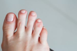 White spots on toenails can be indicative of your health.