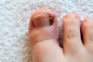 Ingrown toenails, a common nuisance that demands attention.