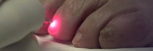 Light the way to healthy nails with laser fungus treatment.