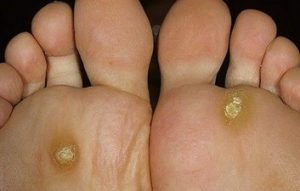 Say goodbye to foot corns with consistent care.