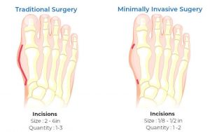 Small incisions, big relief Minimally Invasive Bunion Surgery.
