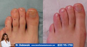Toe shortening surgery, also known as hammertoe correction