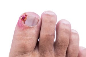 Closeup of inflammation and blood associated with painful ingrown toenail.