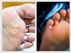 Corns and calluses on the feet can cause discomfort and affect mobility if left untreated.