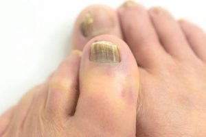 Toenail fungus causes thick, discolored nails; seek treatment today.