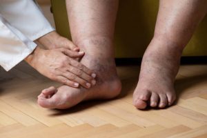 Regular foot checks can help you stay ahead of swelling issues.