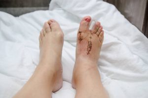 Experience relief and regain comfort with expertly performed bunion surgery