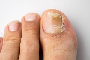 Onychomycosis can be effectively treated with antifungal medications or laser therapy.