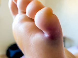 A sprained toe involves stretching or tearing of the ligaments, causing pain, swelling, and bruising that requires proper care for healing.