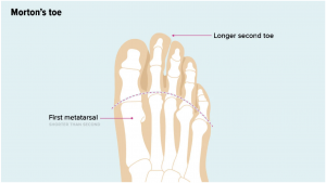 A visual guide to Morton's toe, highlighting the longer second toe. Illustration by Diego Sabogal