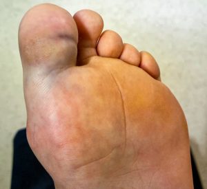 When you sprain your toe, the ligaments around it are injured, causing pain, swelling, and bruising that can affect your ability to walk comfortably.