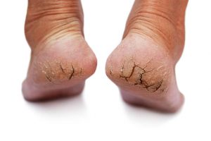 A close-up of deeply cracked heels with dry, flaky skin.