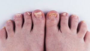 White toenails can result from dryness, trauma, or infection.