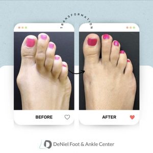 Toe Shortening Before & After