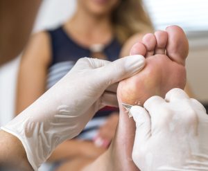 A podiatrist performing debridement to remove a painful callus, providing immediate relief and improving foot health.