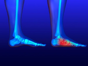 Flat Feet: Causes, Symptoms, Types, Diagnosis and Treatment