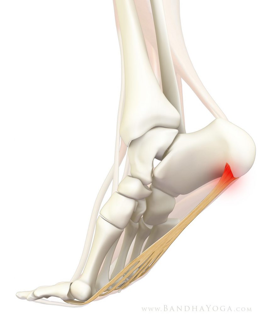 Plantar fasciitis- Symptoms and Causes