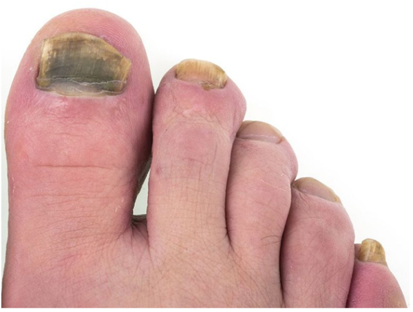 Toenail Fungus Symptoms And Treatment Tips 