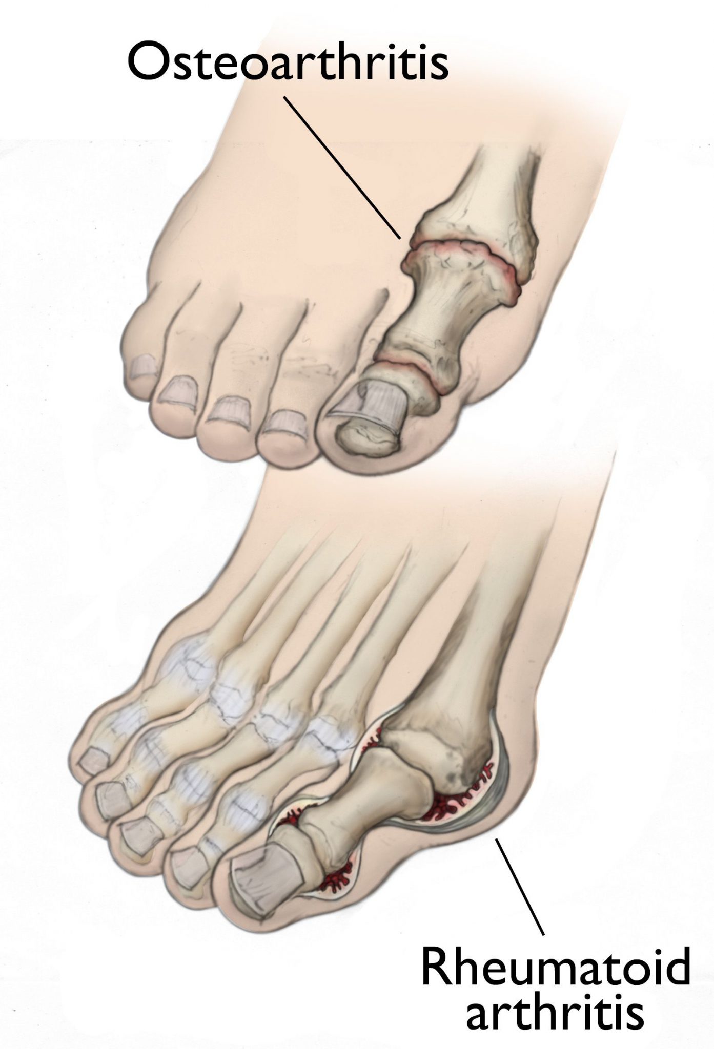 Psoriatic Arthritis Feet Archives Deniel Foot And Ankle Center