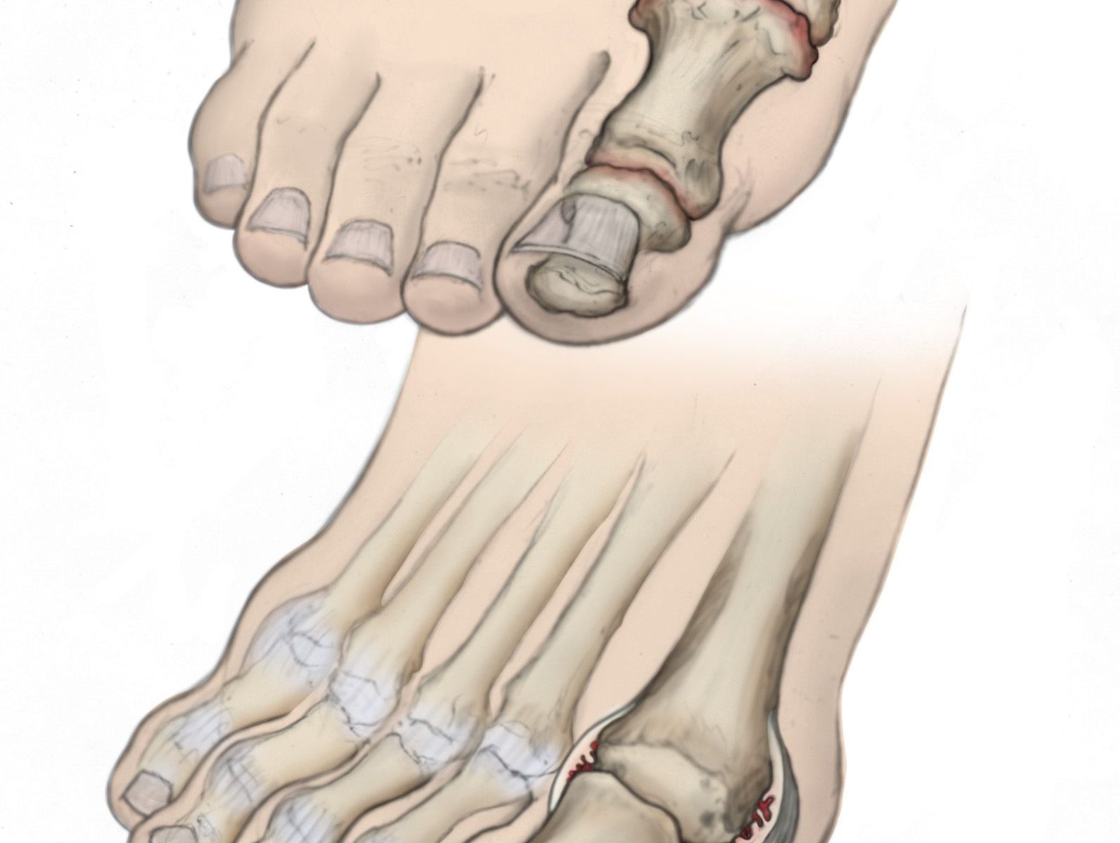 foot arthritis
