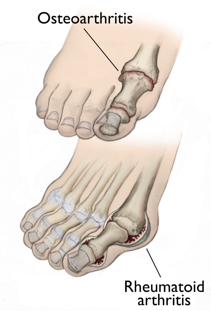 How Arthritis Affects the Feet