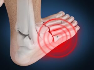 Metatarsal stress fracture