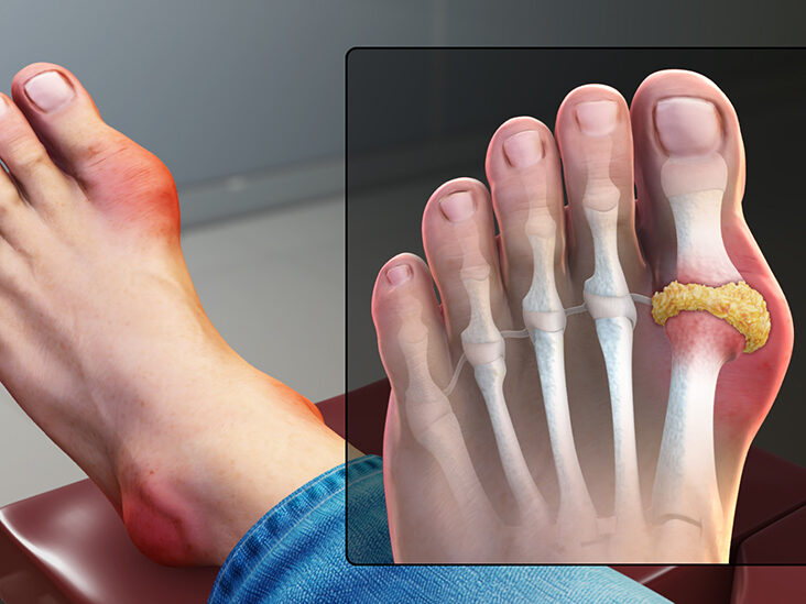 Is Gout the Cause of My Toe Pain?