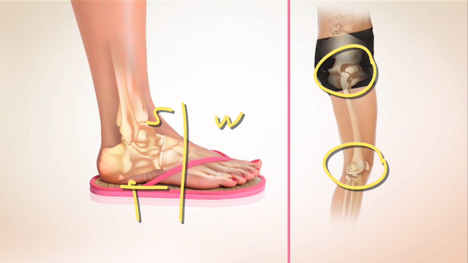 Foot Conditions Caused by Wearing FlipFlops