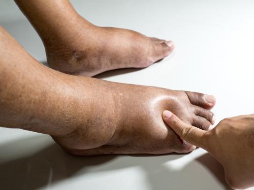 Are Heart Failure and Swollen Feet Connected? Doctors Explain