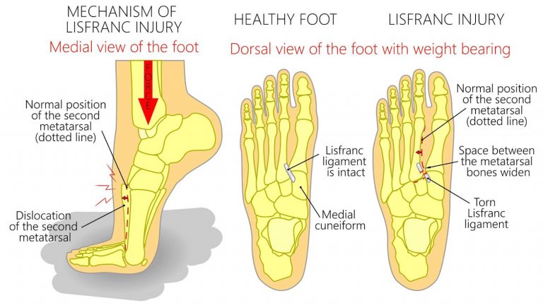 What is a Lisfranc Injury, and How Does It Happen?