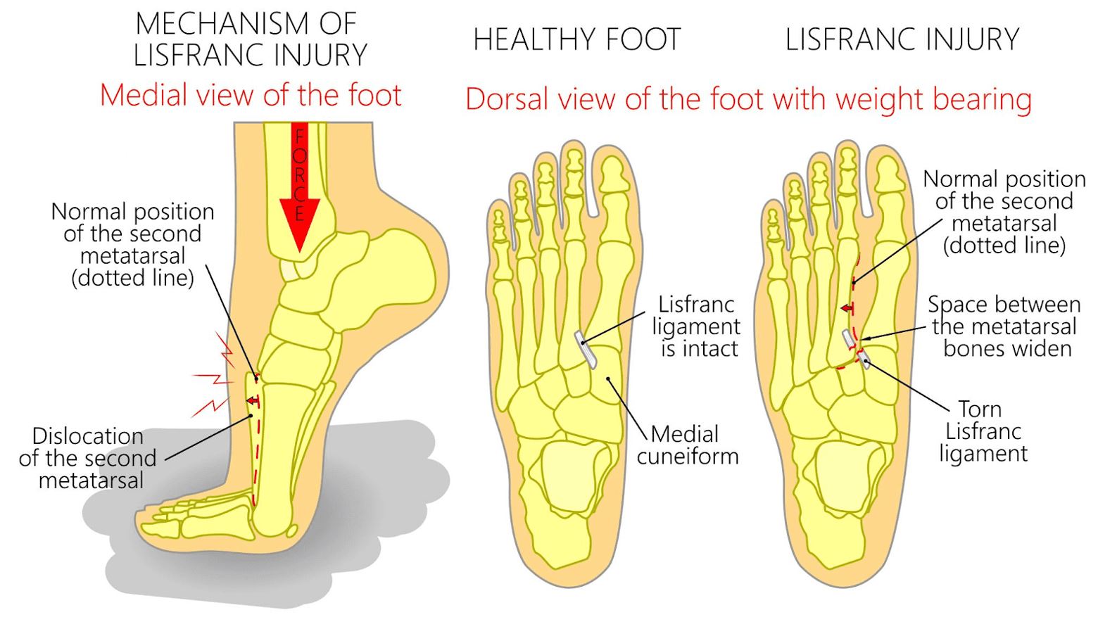 What Is A Lisfranc Injury And How Does It Happen what-is-a-lisfranc-injury-and-how-does-it-happen
