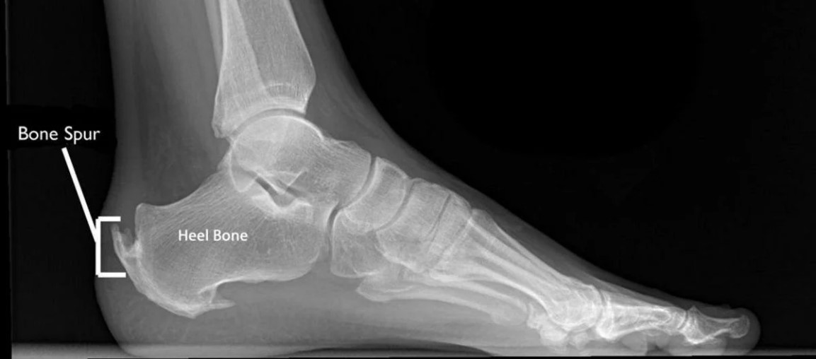 Get Rid Of A Bone Spur Without Surgery