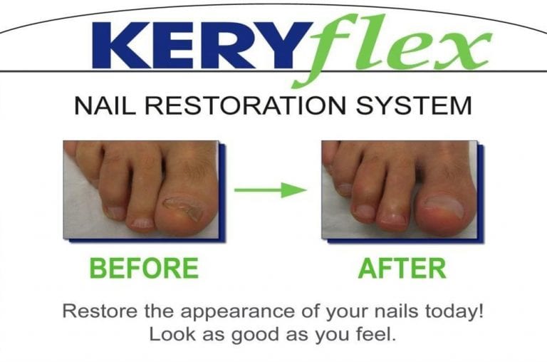 KeryFlex nail restoration before and after, showing a discoloured toenail replaced with a natural-looking nail