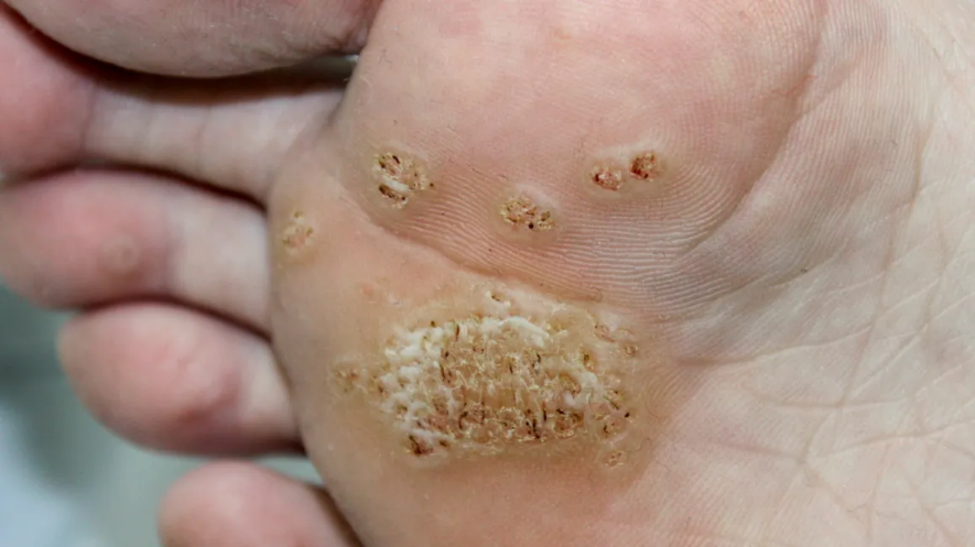 Stages Of Plantar Wart Removal Using Salicylic Acid | Bruin Blog