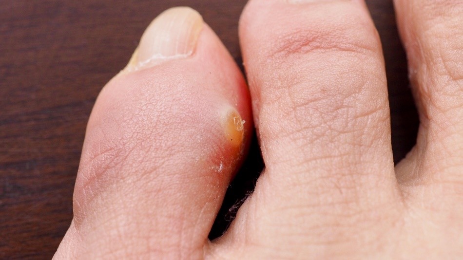 What is a Soft Corn? DeNiel Foot and Ankle Center