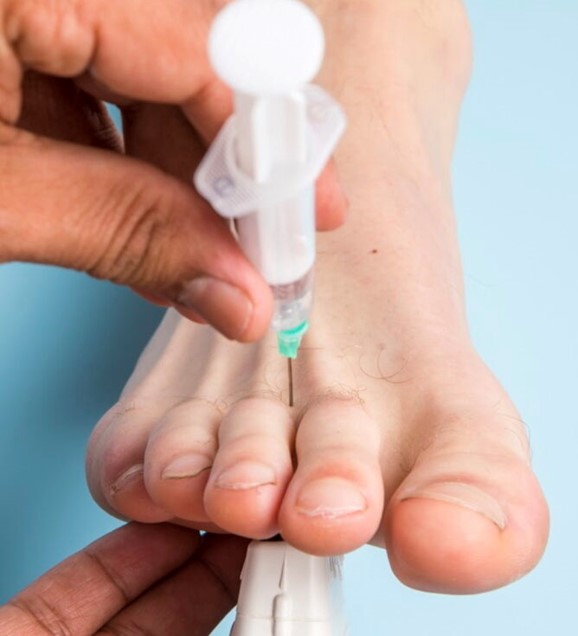 Is A Cortisone Shot Effective in Treating Morton’s Neuroma?