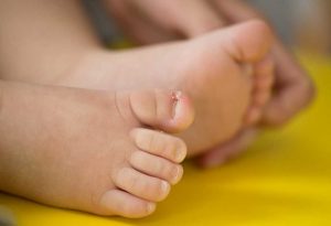 Ingrown toenails in children