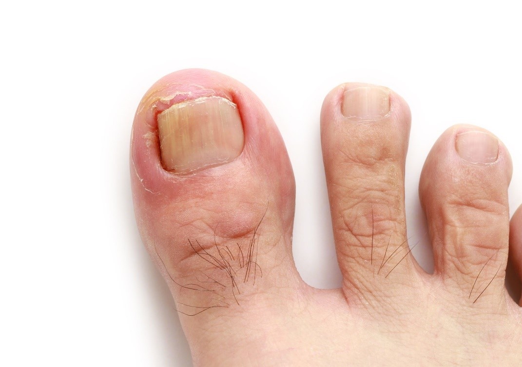 Can A Pedicure Cause Ingrown Nails?