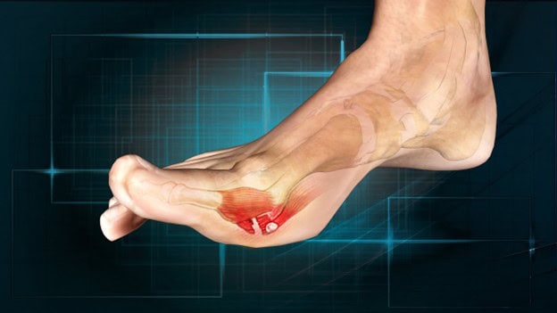 What Are the Options for Treating Turf Toe?