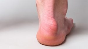 Is a bone spur causing the painful bump on the back of my heel?