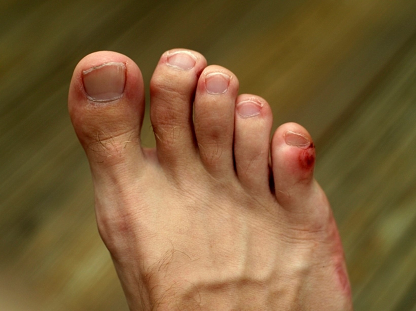 how-to-treat-a-stubbed-toe