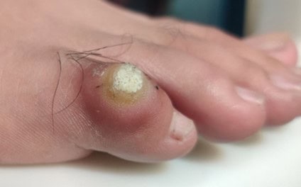 Why It s Essential To Remove Corns Why It s Essential To Remove Corns